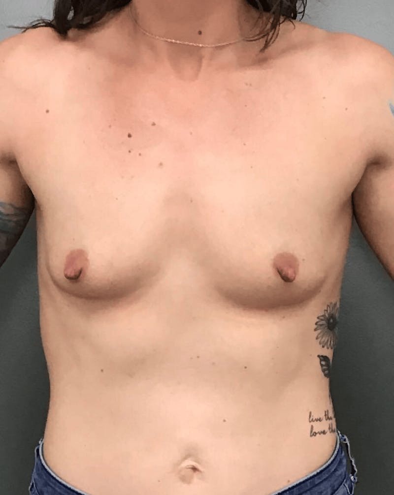 Breast Augmentation Before & After Gallery - Patient 373738 - Image 1
