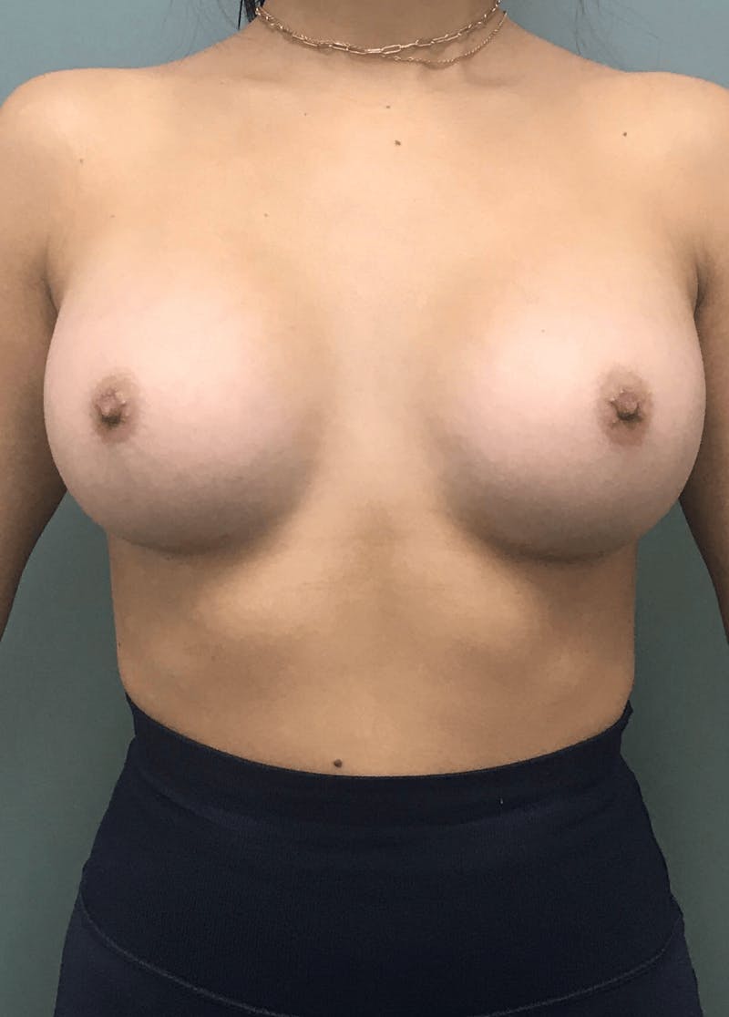 Breast Augmentation Before & After Gallery - Patient 186707 - Image 2