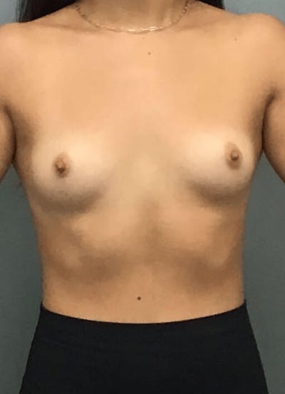 Breast Augmentation Before & After Gallery - Patient 186707 - Image 1
