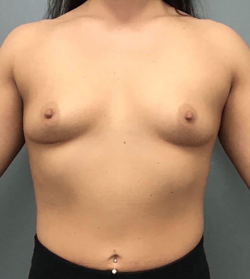 Breast Augmentation Before & After Gallery - Patient 826957 - Image 1