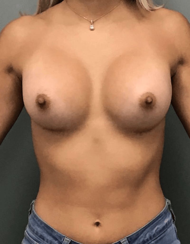 Breast Augmentation Before & After Gallery - Patient 615798 - Image 2