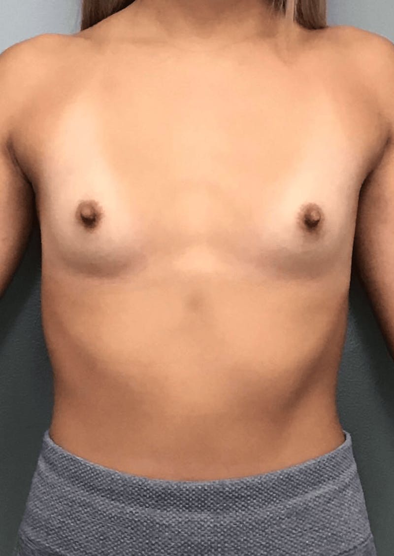 Breast Augmentation Before & After Gallery - Patient 615798 - Image 1