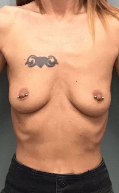 Breast Augmentation Before & After Gallery - Patient 265642 - Image 1