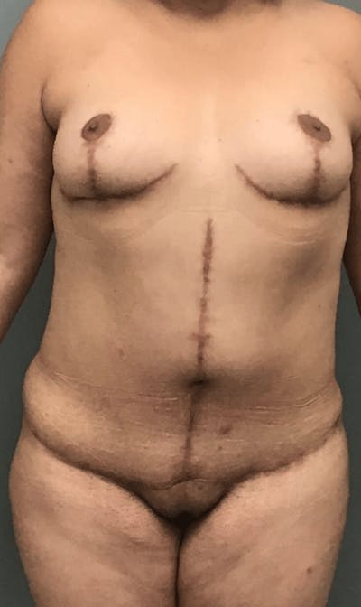 Liposuction Before & After Gallery - Patient 220054 - Image 2