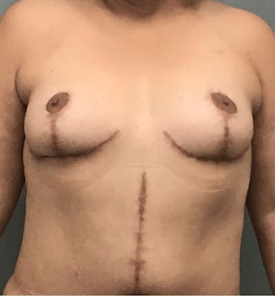 Breast Lift Before & After Gallery - Patient 409985 - Image 2