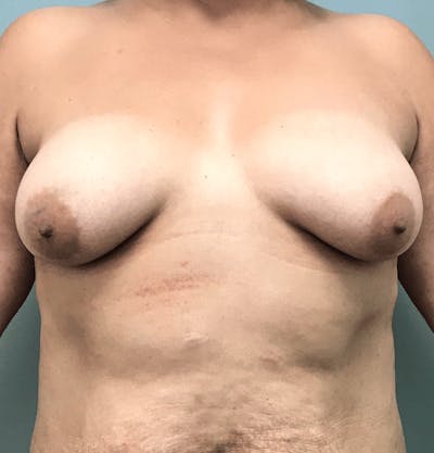 Breast Lift Before & After Gallery - Patient 409985 - Image 1