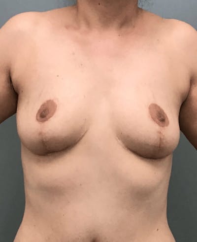 Breast Lift Before & After Gallery - Patient 184208 - Image 2