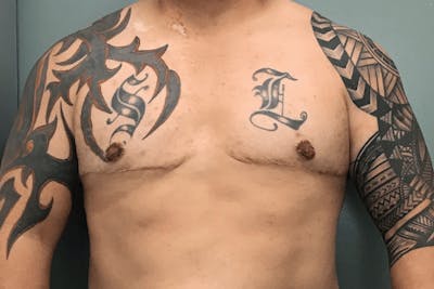 Male Breast Reduction (Gynecomastia) Before & After Gallery - Patient 137334 - Image 2