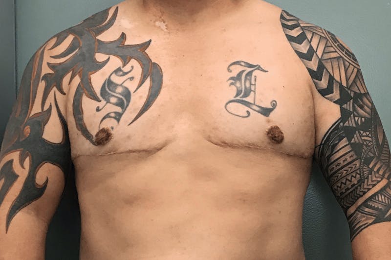 Male Breast Reduction (Gynecomastia) Before & After Gallery - Patient 137334 - Image 2