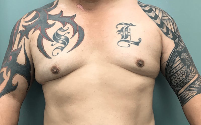 Male Breast Reduction (Gynecomastia) Before & After Gallery - Patient 137334 - Image 1