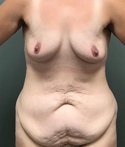 Tummy Tuck Before & After Gallery - Patient 485567 - Image 1