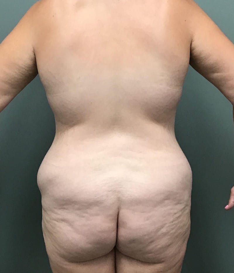 Tummy Tuck Before & After Gallery - Patient 485567 - Image 3