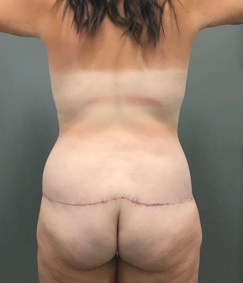 Body Contouring Before & After Gallery - Patient 414632 - Image 4