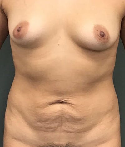 Tummy Tuck Before & After Gallery - Patient 238514 - Image 1