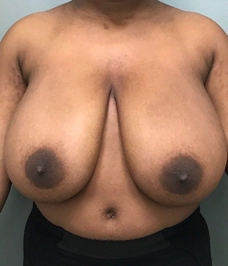 Breast Reduction Before & After Gallery - Patient 350694 - Image 1