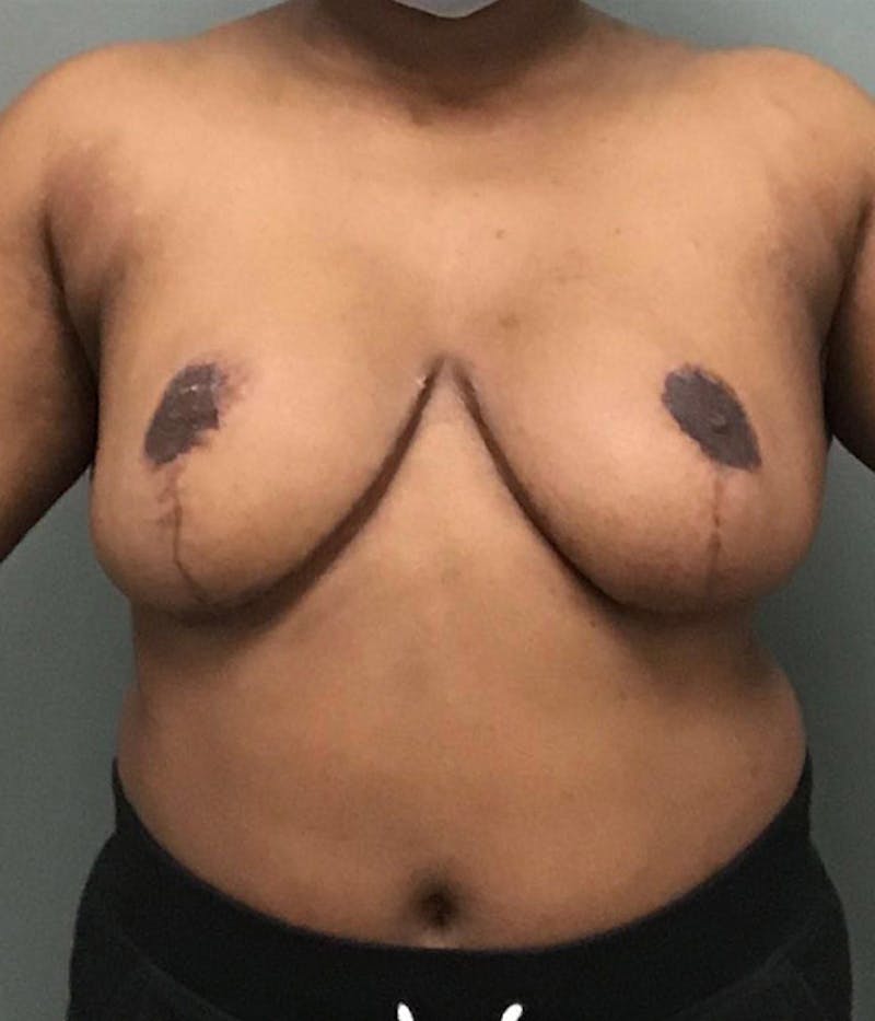 Breast Reduction Before & After Gallery - Patient 350694 - Image 2