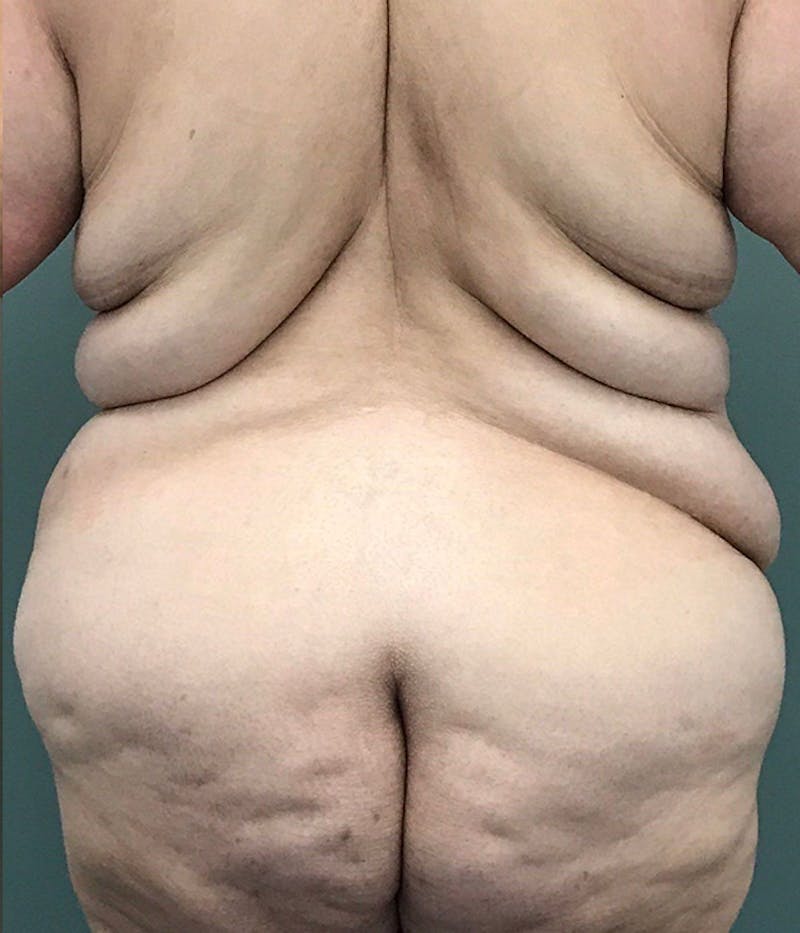 Tummy Tuck Before & After Gallery - Patient 327048 - Image 3