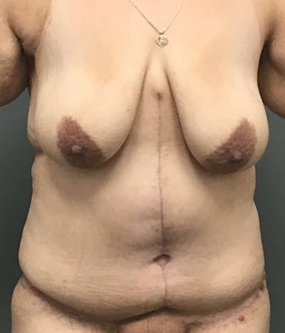 Tummy Tuck Before & After Gallery - Patient 327048 - Image 2