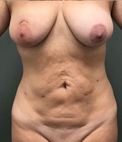 Tummy Tuck Before & After Gallery - Patient 122116 - Image 1