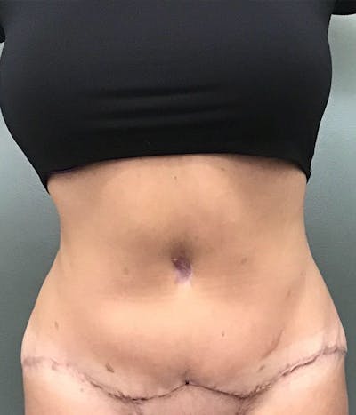 Tummy Tuck Before & After Gallery - Patient 122116 - Image 2