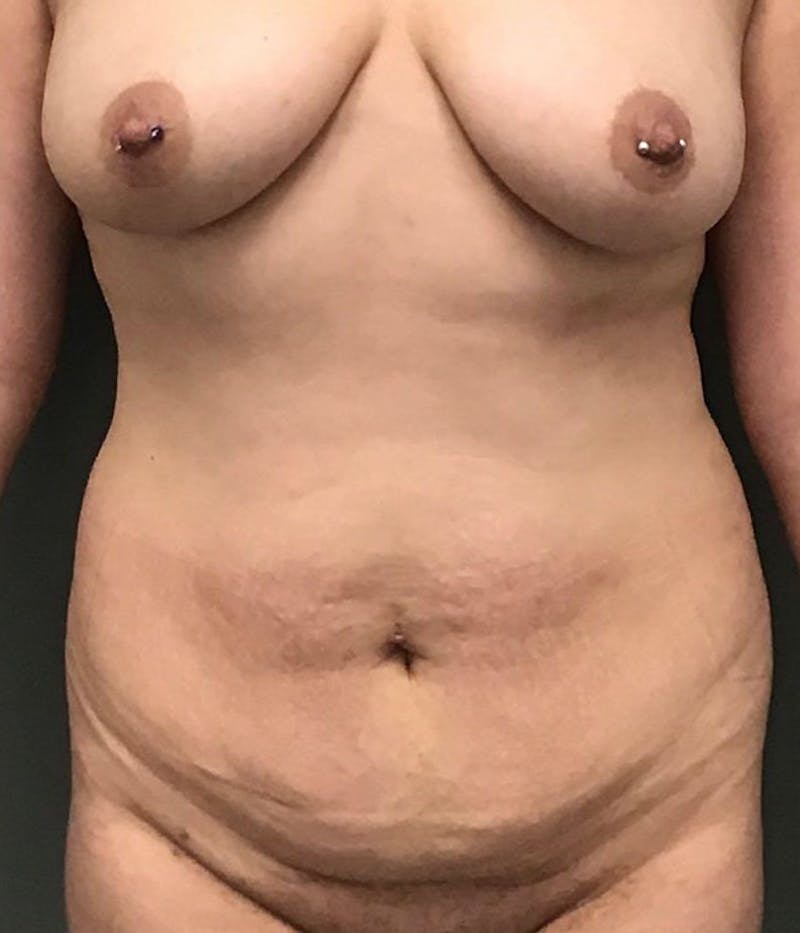 Tummy Tuck Before & After Gallery - Patient 226144 - Image 1