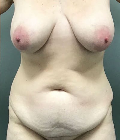 Tummy Tuck Before & After Gallery - Patient 422037 - Image 1