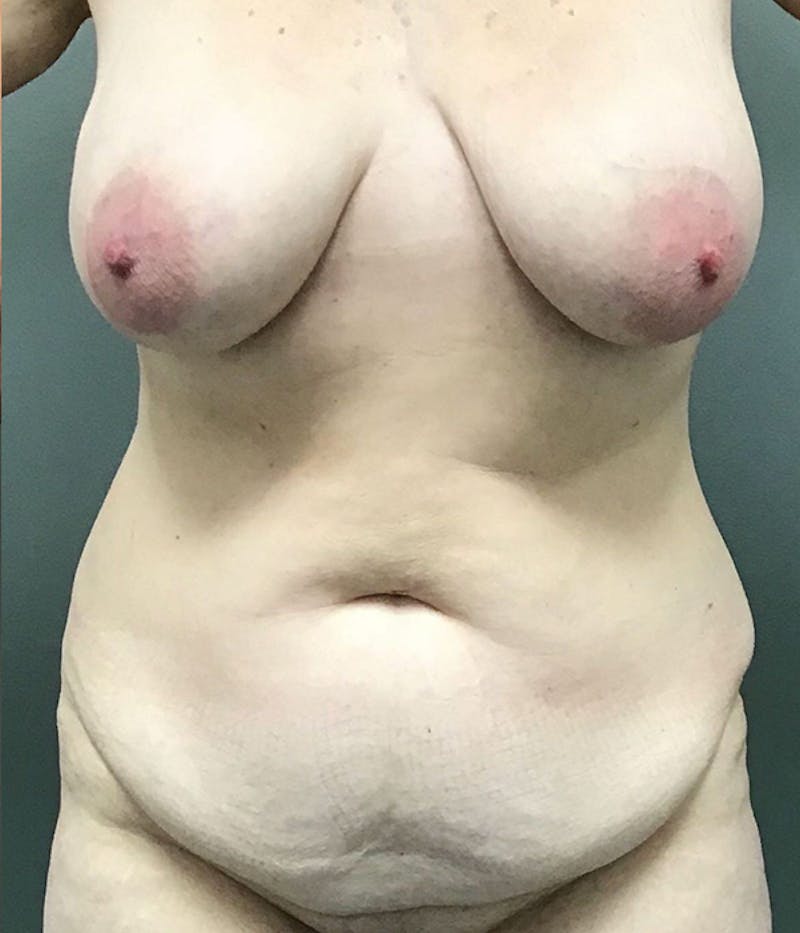 Tummy Tuck Before & After Gallery - Patient 422037 - Image 1