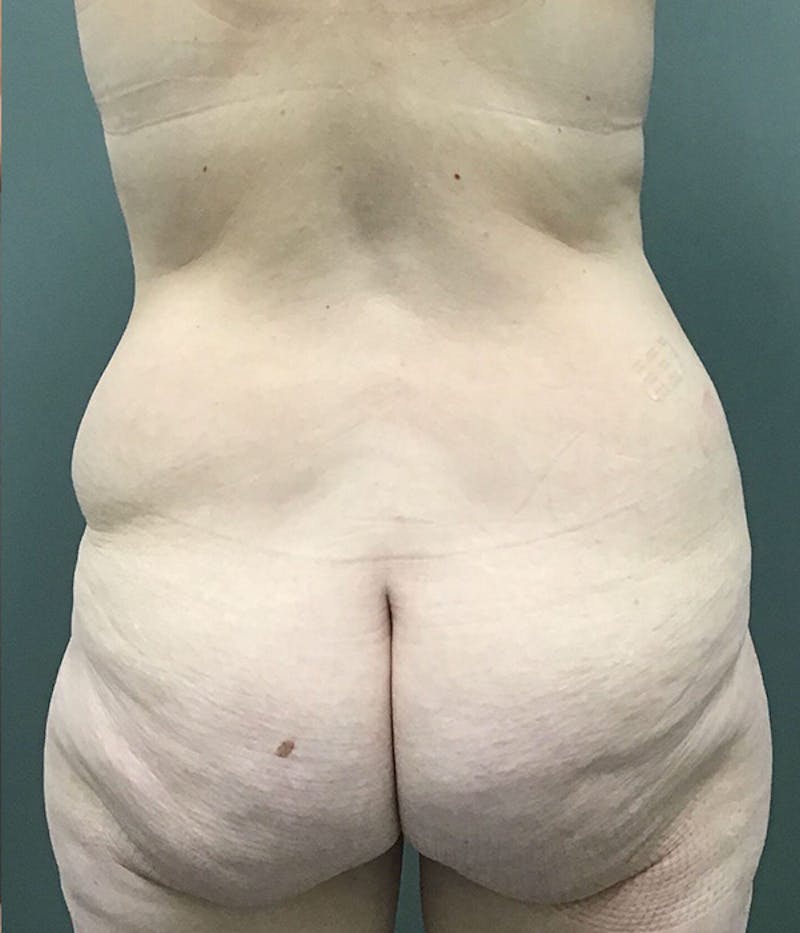 Tummy Tuck Before & After Gallery - Patient 422037 - Image 3