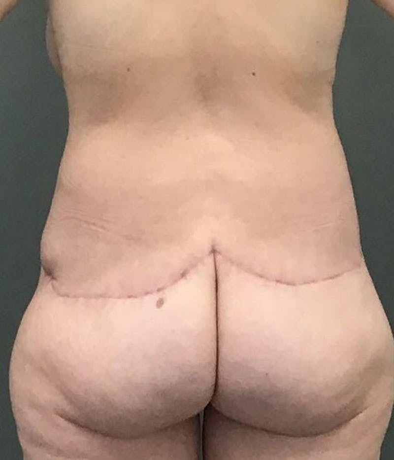 Tummy Tuck Before & After Gallery - Patient 422037 - Image 4