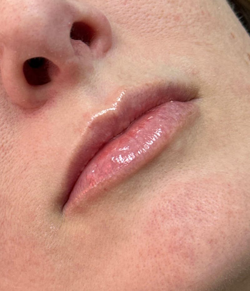 Dermal Fillers Before & After Gallery - Patient 363713 - Image 2