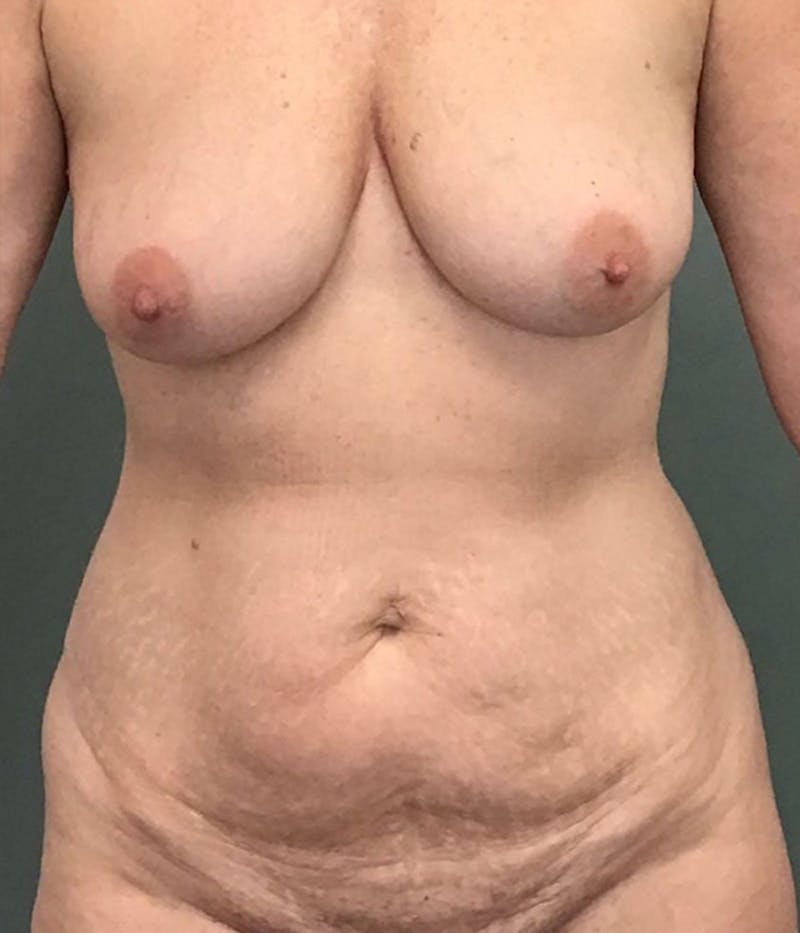Tummy Tuck Before & After Gallery - Patient 295579 - Image 1