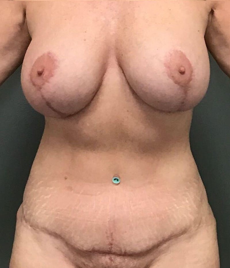 Breast Lift Before & After Gallery - Patient 338388 - Image 2