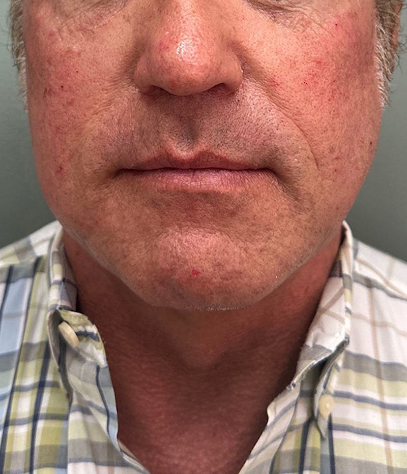 Dermal Fillers Before & After Gallery - Patient 148665 - Image 2