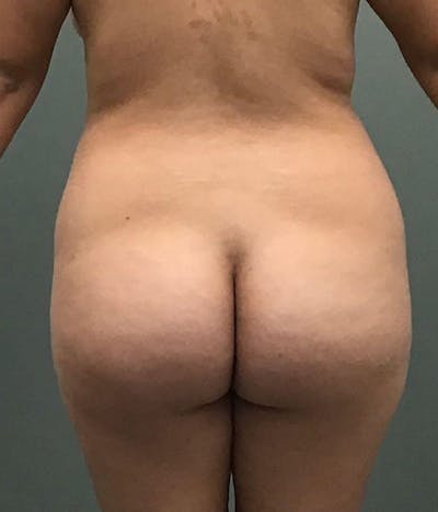 Brazilian Butt Lift Before & After Gallery - Patient 703895 - Image 1