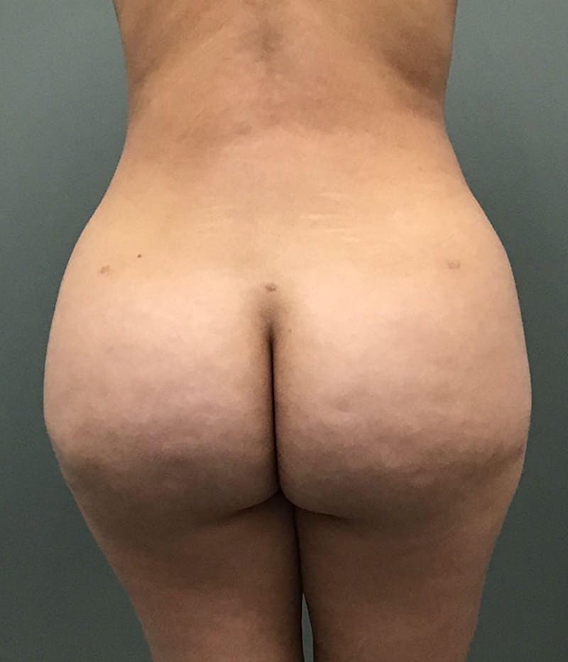 Brazilian Butt Lift Before & After Gallery - Patient 703895 - Image 2