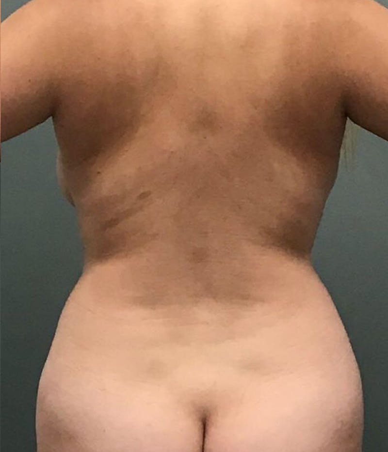 Liposuction Before & After Gallery - Patient 463830 - Image 3