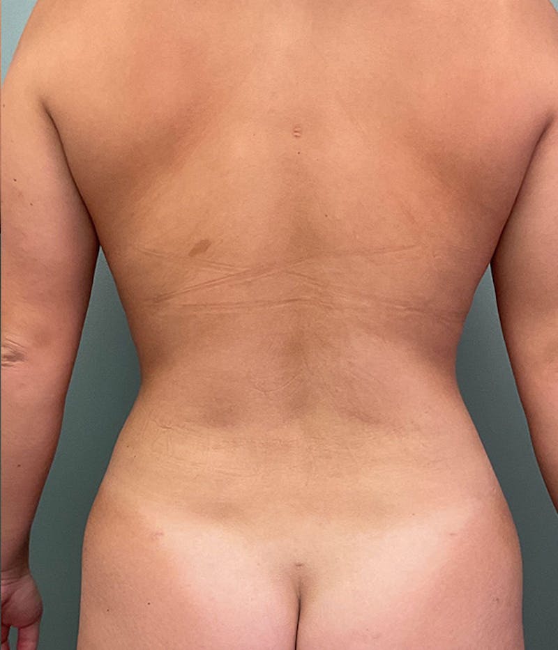 Liposuction Before & After Gallery - Patient 463830 - Image 4