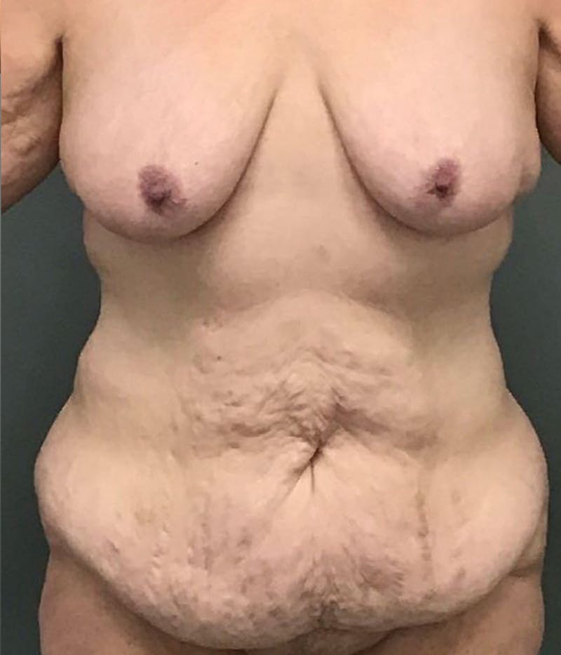Body Contouring Before & After Gallery - Patient 104587 - Image 1