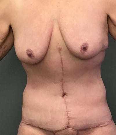 Body Contouring Before & After Gallery - Patient 104587 - Image 2
