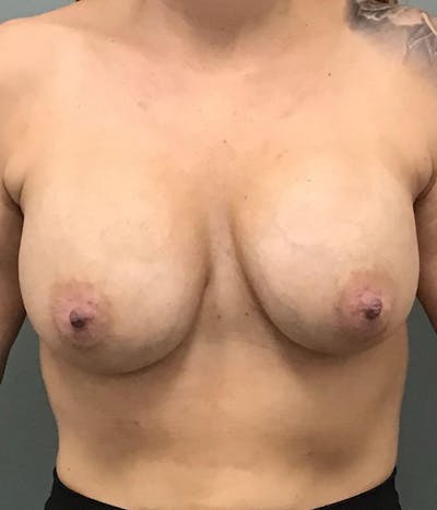 Breast Revision Before & After Gallery - Patient 233868 - Image 1