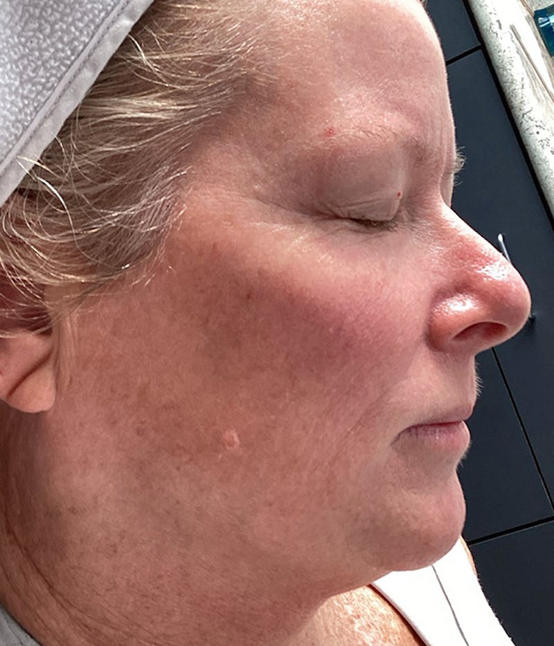 Microneedling Before & After Gallery - Patient 105910 - Image 2