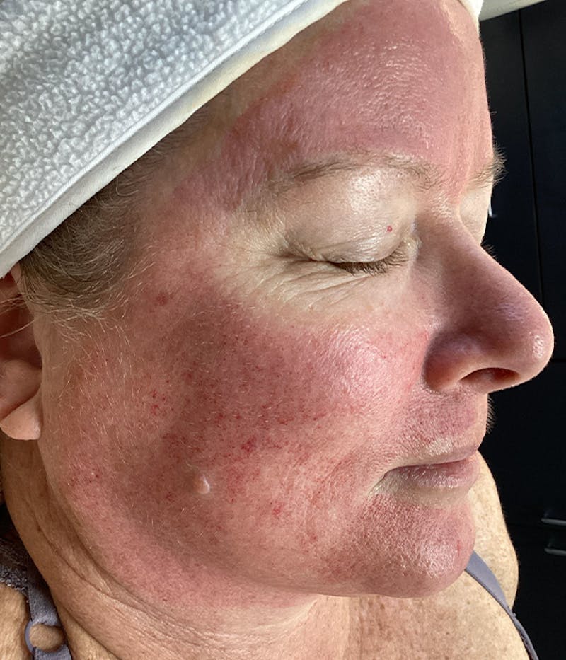 Microneedling Before & After Gallery - Patient 105910 - Image 1