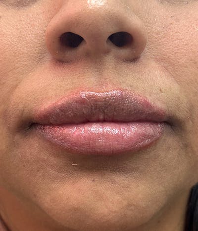 Dermal Fillers Before & After Gallery - Patient 189106 - Image 2