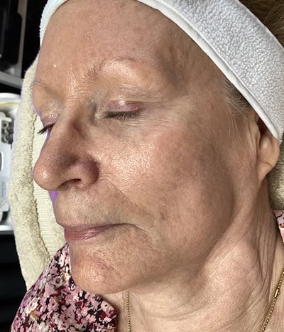 Microneedling Before & After Gallery - Patient 290956 - Image 1