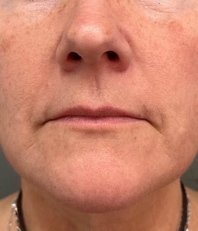 Dermal Fillers Before & After Gallery - Patient 178583 - Image 1