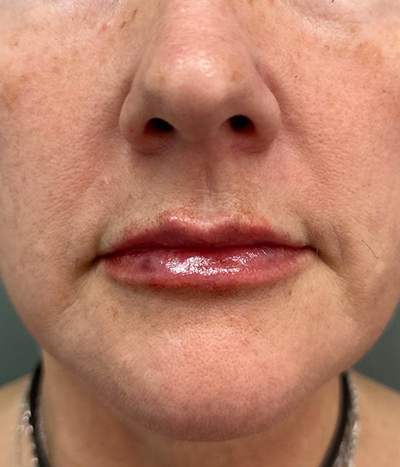 Dermal Fillers Before & After Gallery - Patient 178583 - Image 2