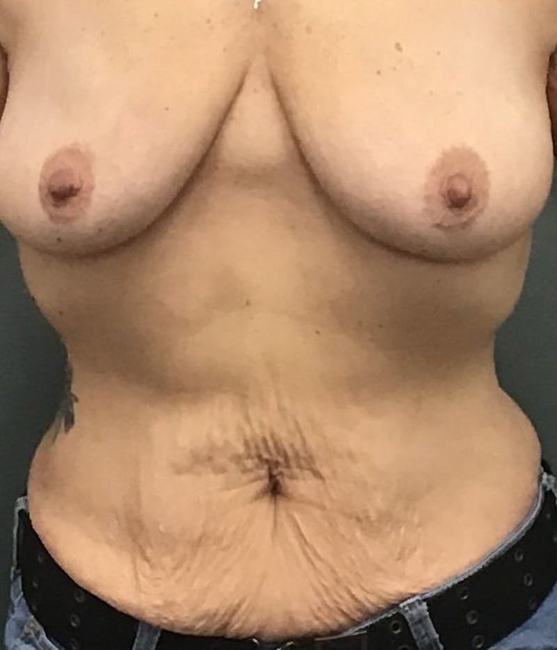Tummy Tuck Before & After Gallery - Patient 121708 - Image 2