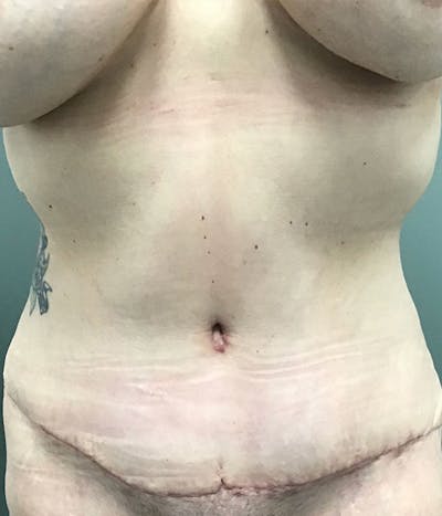Tummy Tuck Before & After Gallery - Patient 121708 - Image 1