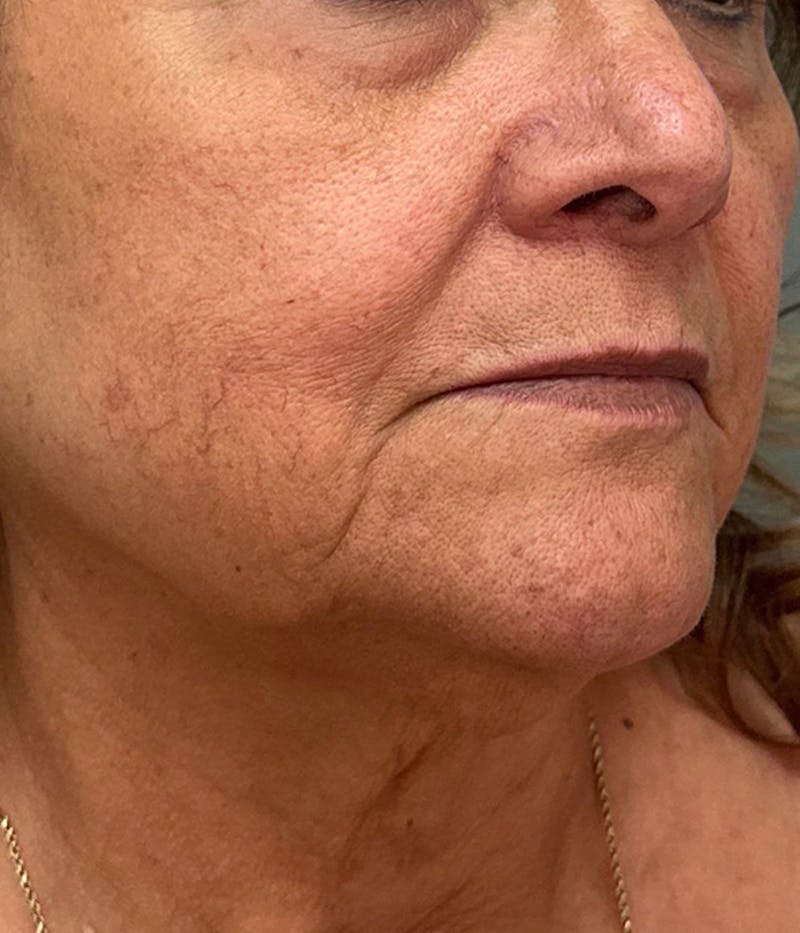 Dermal Fillers Before & After Gallery - Patient 360499 - Image 3