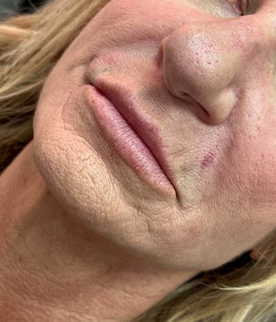 Dermal Fillers Before & After Gallery - Patient 610876 - Image 1